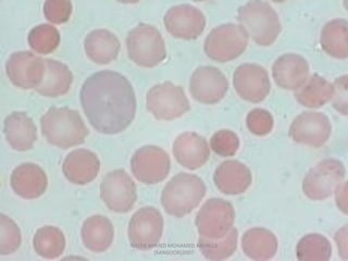 Morphological abnormality of red blood cell | PDF