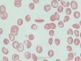 Morphological abnormality of red blood cell | PDF