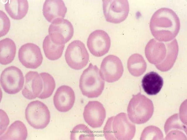 Morphological abnormality of red blood cell | PDF