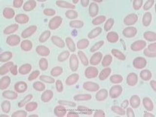 Morphological abnormality of red blood cell | PDF