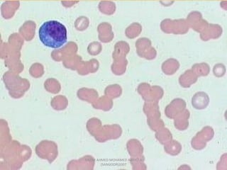 Morphological abnormality of red blood cell | PDF