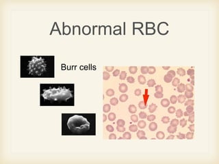 Abnormal RBC
Burr cells
 