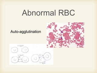 Abnormal RBC
Auto-agglutination
 