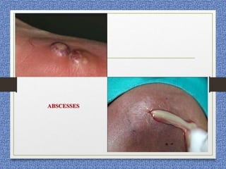 ABSCESSES
 