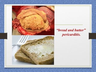 “bread and butter”
pericarditis.
 