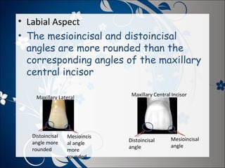 • Labial Aspect
• The mesioincisal and distoincisal
angles are more rounded than the
corresponding angles of the maxillary
central incisor
Maxillary Lateral

Distoincisal
angle more
rounded

Mesioincis
al angle
more
rounded

Maxillary Central Incisor

Distoincisal
angle

Mesioincisal
angle

 