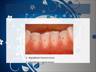 2

1

1

1 : Mandibular Central Incisor
2 : Mandibular Lateral Incisor

2

 