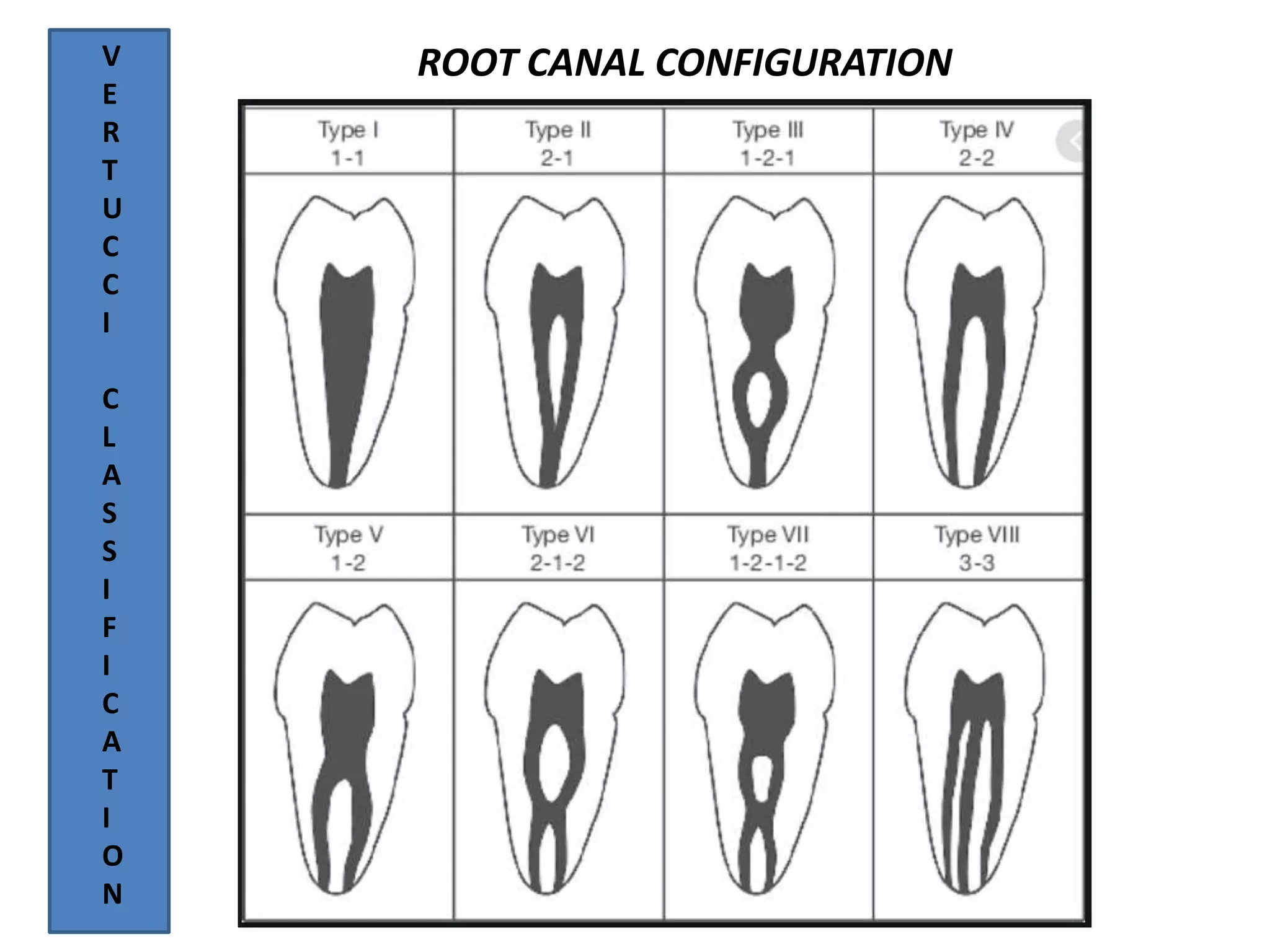 ROOT CANAL CONFIGURATIONV
E
R
T
U
C
C
I
C
L
A
S
S
I
F
I
C
A
T
I
O
N
 