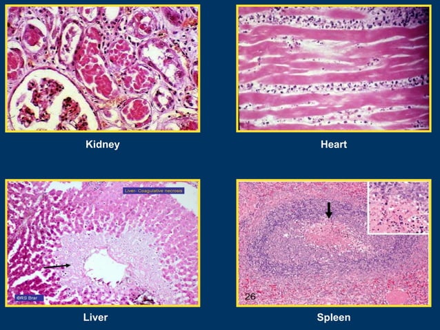 Coagulative Necrosis   Morphology
