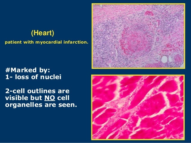 Coagulative Necrosis   Morphology