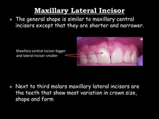 Maxillary Lateral Incisor
 The general shape is similar to maxillary central
incisors except that they are shorter and narrower.
 Next to third molars maxillary lateral incisors are
the teeth that show most variation in crown size,
shape and form
Maxillary central incisor bigger
and lateral incisor smaller
 