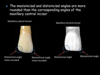 The mesioincisal and distoincisal angles are more
rounded than the corresponding angles of the
maxillary central incisor
Distoincisal angle
more rounded
Mesioincisal angle
more rounded
Maxillary Lateral Incisor
Maxillary Central Incisor
Mesioincisal angleDistoincisal angle
 