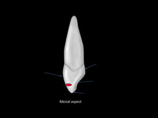 Mesial aspect
 