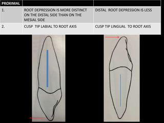 PROXIMAL
1. ROOT DEPRESSION IS MORE DISTINCT
ON THE DISTAL SIDE THAN ON THE
MESIAL SIDE
DISTAL ROOT DEPRESSION IS LESS
2. CUSP TIP LABIAL TO ROOT AXIS CUSP TIP LINGUAL TO ROOT AXIS
 
