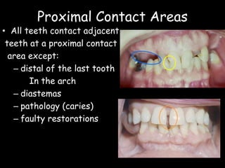 Proximal Contact Areas
• All teeth contact adjacent
teeth at a proximal contact
area except:
– distal of the last tooth
In the arch
– diastemas
– pathology (caries)
– faulty restorations
 