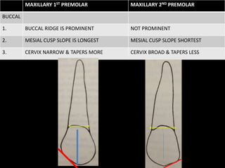 MAXILLARY 1ST PREMOLAR MAXILLARY 2ND PREMOLAR
BUCCAL
1. BUCCAL RIDGE IS PROMINENT NOT PROMINENT
2. MESIAL CUSP SLOPE IS LONGEST MESIAL CUSP SLOPE SHORTEST
3. CERVIX NARROW & TAPERS MORE CERVIX BROAD & TAPERS LESS
 