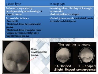 3 cusp type 2 cusp type
Each cusp is separated by
developmental groove forming a Y
shape in centre
Mesiolingual and distolingual line angle
are rounded
Occlusal outline is U shaped
Occlusal also include –
•Central pit
•Mesial and distal developmental
groove
•Mesial and distal triangular fossa
•Lingual developmental groove
•Supplemental groove
Central groove travels mesiodistally ends
in mesial and distal fossa.
Distal
developmental
groove
 