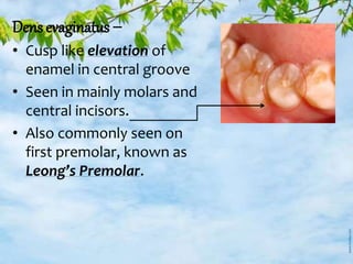 Dens evaginatus –
• Cusp like elevation of
enamel in central groove
• Seen in mainly molars and
central incisors.
• Also commonly seen on
first premolar, known as
Leong’s Premolar.
 