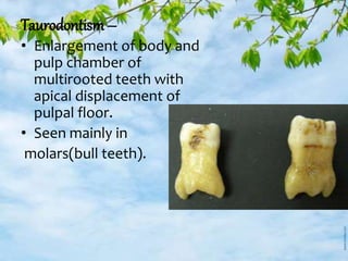 Taurodontism –
• Enlargement of body and
pulp chamber of
multirooted teeth with
apical displacement of
pulpal floor.
• Seen mainly in
molars(bull teeth).
 