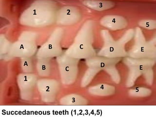 Succedaneous teeth (1,2,3,4,5)
1 2
3
4
5
A B C D E
1
2
3
4 5
A
B C
D E
 