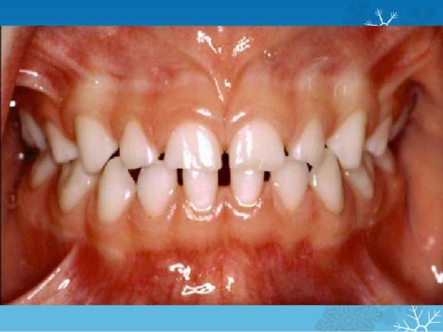 morphology of primary teeth primary teeth