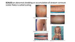 Outer Scale In Rash MORPHOLOGY OF SKIN LESIONS powerpoint dvl | PPTX