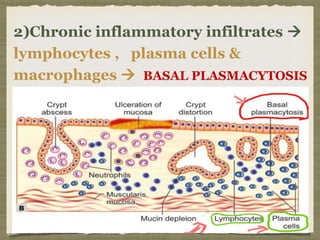 2)Chronic inflammatory infiltrates 
lymphocytes , plasma cells &
macrophages  BASAL PLASMACYTOSIS
 