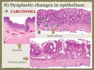 8) Dysplastic changes in epithelium
 CARCINOMA
Chronic phase
Acute phase
Normal
 
