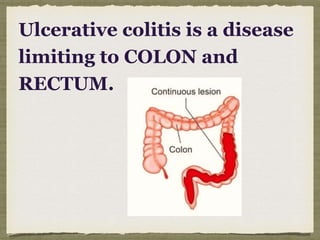 Ulcerative colitis is a disease
limiting to COLON and
RECTUM.
 