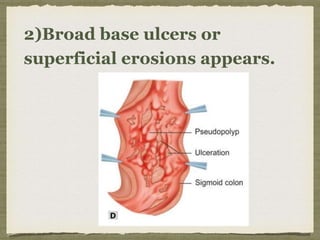 2)Broad base ulcers or
superficial erosions appears.
 