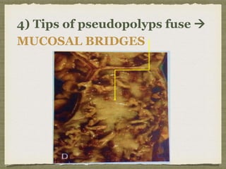 4) Tips of pseudopolyps fuse 
MUCOSAL BRIDGES
 