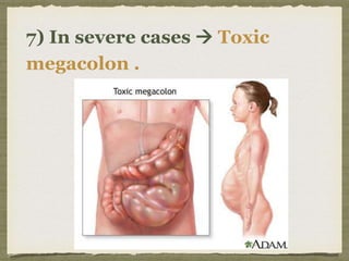 7) In severe cases  Toxic
megacolon .
 