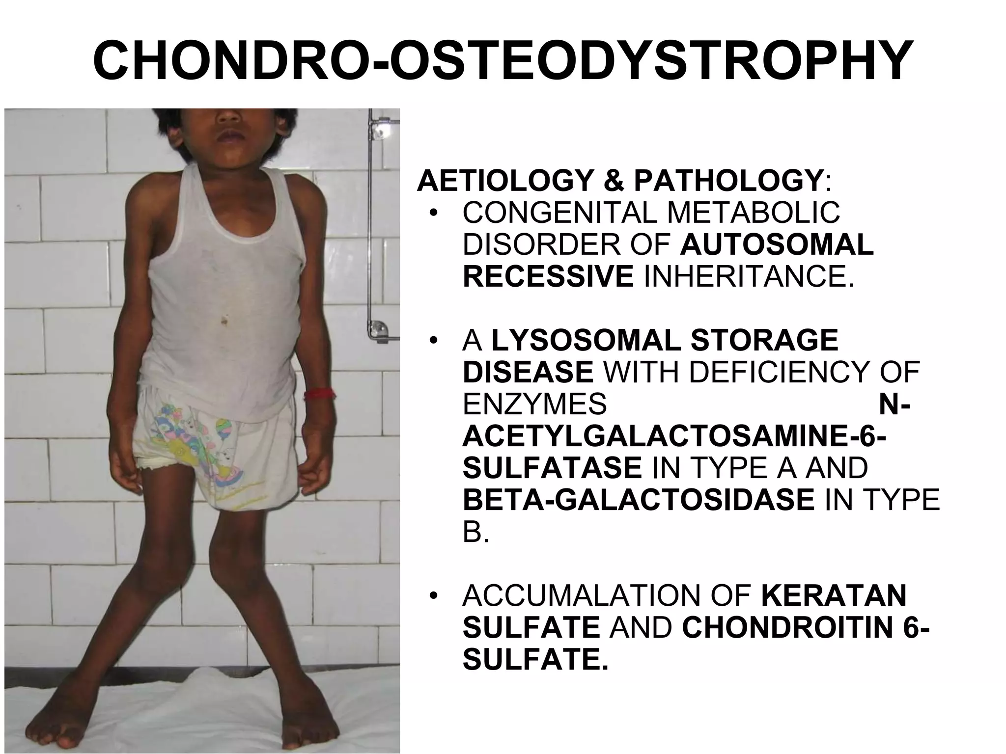 Morquio syndrome | PPT