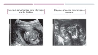 Distorsión anatómica con maceración
avanzada.
Edema de partes blandas. Signo intermedio
a tardío de óbito.
 