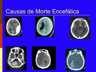 Causas de Morte Encefálica
 