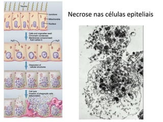 Necrose nas células epiteliais

 