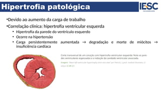 Hipertrofia patológica
•Devido ao aumento da carga de trabalho
•Correlação clínica: hipertrofia ventricular esquerda
• Hipertrofia da parede do ventrículo esquerdo
• Ocorre na hipertensão
• Carga persistentemente aumentada → degradação e morte de miócitos →
insuficiência cardíaca
 