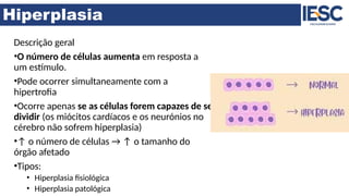 Hiperplasia
Descrição geral
•O número de células aumenta em resposta a
um estímulo.
•Pode ocorrer simultaneamente com a
hipertrofia
•Ocorre apenas se as células forem capazes de se
dividir (os miócitos cardíacos e os neurónios no
cérebro não sofrem hiperplasia)
•↑ o número de células → ↑ o tamanho do
órgão afetado
•Tipos:
• Hiperplasia fisiológica
• Hiperplasia patológica
 