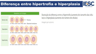 Diferença entre hipertrofia e hiperplasia
 