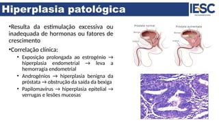 Hiperplasia patológica
•Resulta da estimulação excessiva ou
inadequada de hormonas ou fatores de
crescimento
•Correlação clínica:
• Exposição prolongada ao estrogénio →
hiperplasia endometrial → leva a
hemorragia endometrial
• Androgénios → hiperplasia benigna da
próstata → obstrução da saída da bexiga
• Papilomavírus → hiperplasia epitelial →
verrugas e lesões mucosas
 