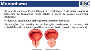 Mecanismo
•Resulta da estimulação por fatores de crescimento → As células maduras
proliferam ou formam-se novas células a partir de células estaminais
tecidulares
•A hiperplasia pode parar assim que o estímulo for removido.
•Estimulação não restrita → proliferação persistente e aumento da
probabilidade de mutações genéticas → aumento do risco de cancro (tumor).
 