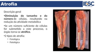 Atrofia
Descrição geral
•Diminuição do tamanho e do
número de células, resultando na
redução da atividade metabólica
•Se um número suficiente de células
for submetido a este processo, o
órgão torna-se atrófico.
•2 tipos de atrofia:
• Fisiológica
• Patológica
 