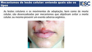 Mecanismos de lesão celular: entenda quais são os
tipos
As lesões celulares e os movimentos de adaptação, bem como de morte
celular, são desencadeadas por mecanismos que objetivam evitar a morte
celular, ou mesmo prevenir um evento adverso orgânico.
 