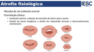 Atrofia fisiológica
•Resulta de um estímulo normal
•Correlação clínica:
• Involução uterina: redução do tamanho do útero após o parto
• Atrofia do ducto tiroglosso e atrofia do notocórdio durante o desenvolvimento
embrionário
 