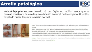 Atrofia patológica
Nota: A hipoplasia ocorre quando há um órgão ou tecido menor que o
normal, resultante de um desenvolvimento anormal ou incompleto. O tecido
envolvido nunca teve um tamanho normal.
 