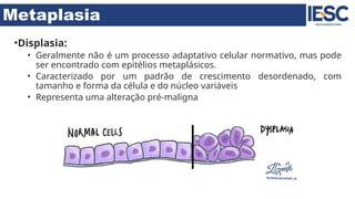 Metaplasia
•Displasia:
• Geralmente não é um processo adaptativo celular normativo, mas pode
ser encontrado com epitélios metaplásicos.
• Caracterizado por um padrão de crescimento desordenado, com
tamanho e forma da célula e do núcleo variáveis
• Representa uma alteração pré-maligna
 