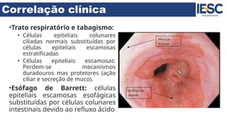 Correlação clínica
•Trato respiratório e tabagismo:
• Células epiteliais colunares
ciliadas normais substituídas por
células epiteliais escamosas
estratificadas
• Células epiteliais escamosas:
Perdem-se mecanismos
duradouros mas protetores (ação
ciliar e secreção de muco).
•Esófago de Barrett: células
epiteliais escamosas esofágicas
substituídas por células colunares
intestinais devido ao refluxo ácido
 