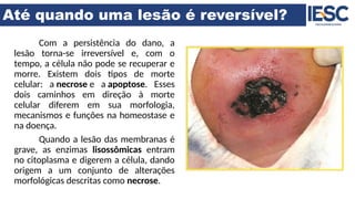 Até quando uma lesão é reversível?
Com a persistência do dano, a
lesão torna-se irreversível e, com o
tempo, a célula não pode se recuperar e
morre. Existem dois tipos de morte
celular: a necrose e a apoptose. Esses
dois caminhos em direção à morte
celular diferem em sua morfologia,
mecanismos e funções na homeostase e
na doença.
Quando a lesão das membranas é
grave, as enzimas lisossômicas entram
no citoplasma e digerem a célula, dando
origem a um conjunto de alterações
morfológicas descritas como necrose.
 
