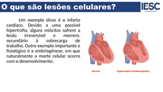 O que são lesões celulares?
Um exemplo disso é o infarto
cardíaco. Devido a uma possível
hipertrofia, alguns miócitos sofrem a
lesão irreversível e morrem,
secundário à sobrecarga de
trabalho. Outro exemplo importante e
fisiológico é a embriogênese, em que
naturalmente a morte celular ocorre
com o desenvolvimento.
 
