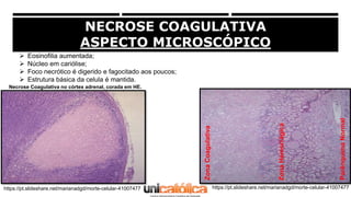 NECROSE COAGULATIVA
ASPECTO MICROSCÓPICO
 Eosinofilia aumentada;
 Núcleo em cariólise;
 Foco necrótico é digerido e fag...